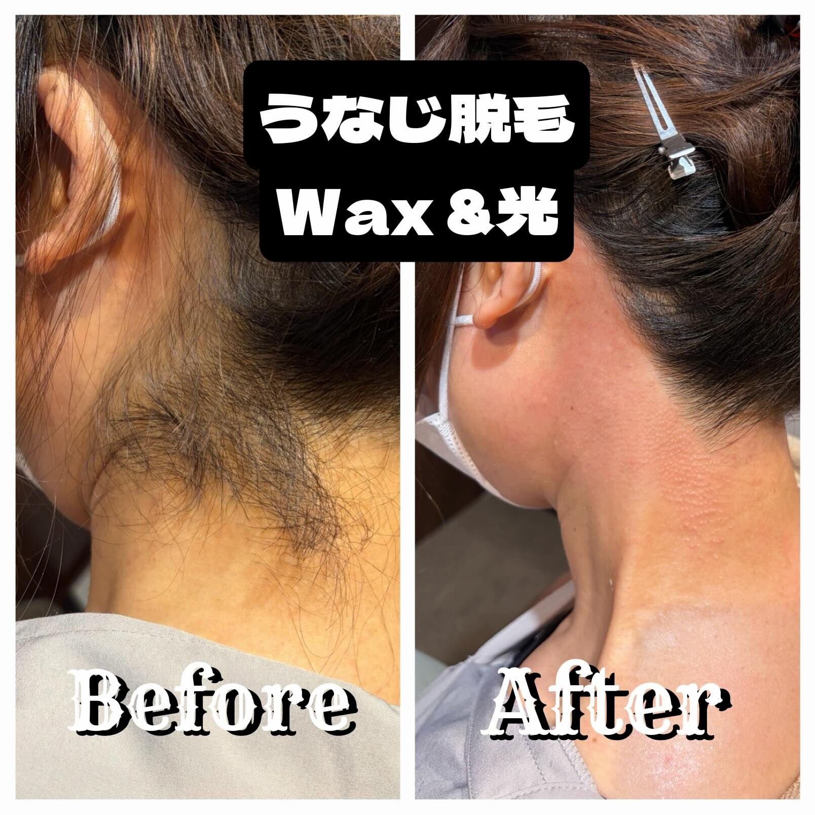 🌊 うなじWax ＋ 光脱毛